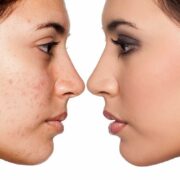 How To Get Clear Skin : Simple Tips & Treated Results How To Get Clear Skin