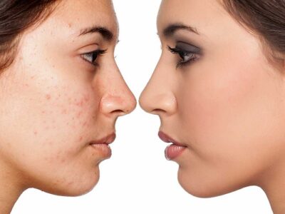 How To Get Clear Skin