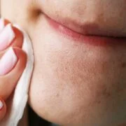 How To Remove Pimples | Easy Tips Proven Results How To Remove Pimples Easy Tips Proven Results