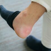 Tips To Cure Shoe Bite Marks – Home Made Remedies Tips To Cure Shoe Bite Marks – Home Made Remedies