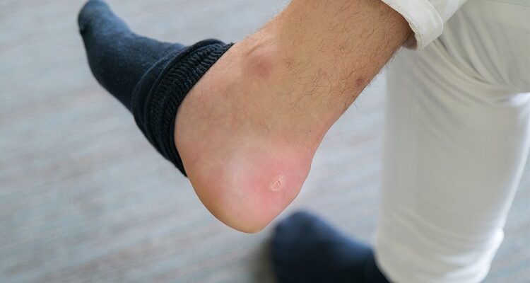 Tips To Cure Shoe Bite Marks – Home Made Remedies